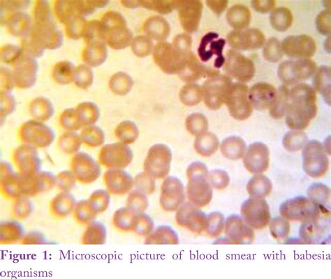 Figure 1 From Clinical Management Of Babesiosis In Cattle A Case