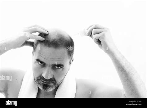 Middle Aged Man Concerned By Hair Loss Bald Baldness Alopecia Black And White On White