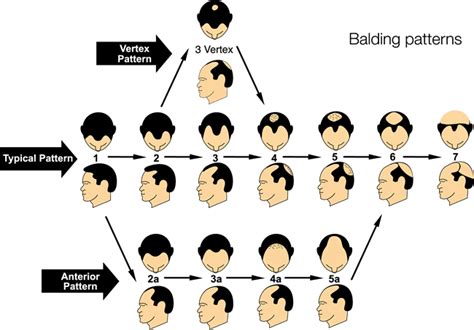 How Many Different Hair Loss Types Are There Which One Is