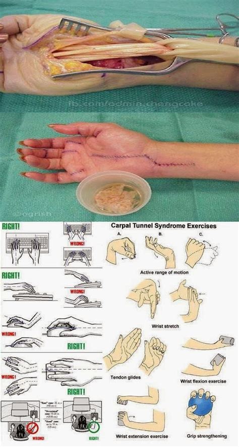 The carpal tunnel is a rigid and narrow passageway for bones and ligaments that houses the median nerve and tendons. The Wealth of Health: Exercise to Prevent Carpal Tunnel ...