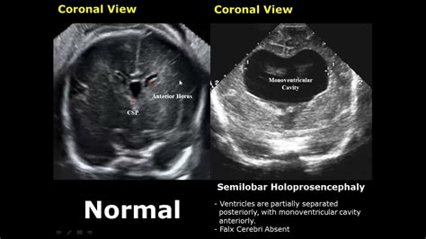 Fetal Brain Ultrasound Normal Vs Abnormal Image Appearances Comparison Fetal Brain Pathologies
