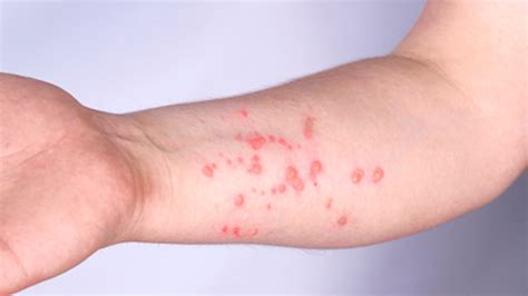 3 Signs You May Have Monkeypox Theu