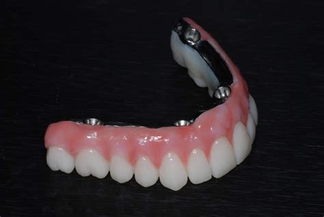 All On Denture Implant Prosthesis Material North Texas Dental Surgery