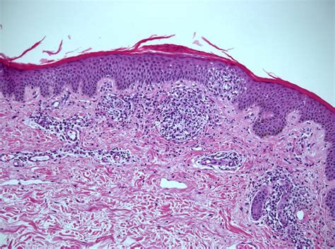 Epidermis With Focal Parakeratosis And Superficial Perivascular