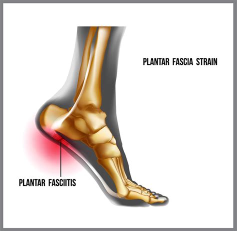 plantar fasciitis what is it and do i have it scerbo physical therapy