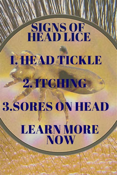 Signs And Symptoms Of Lice Signs And Symptoms Louse Head Lice Nits