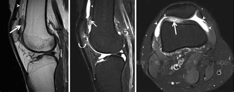 Prefemoral Fat Pad Impingement In A 42 Year Old Woman With Anterior