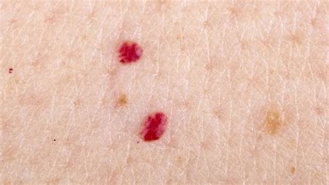 Understanding Tiny Red Blood Spots On Skin Dont Ignore These Signs