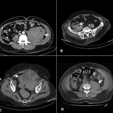 Retroperitoneal Hematomas On The Axial Ct Scan Of The Abdomen And