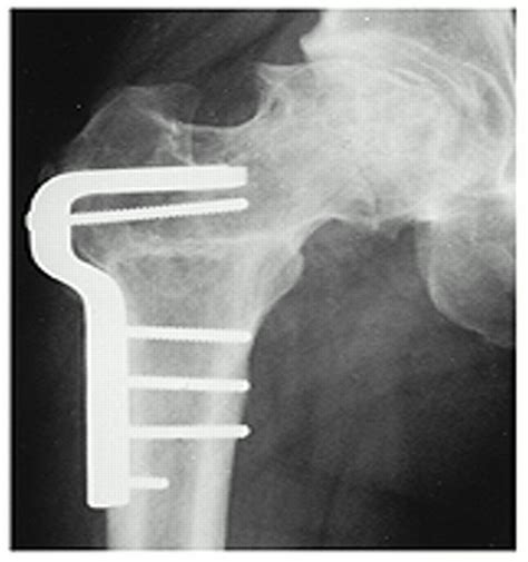 Corrective Osteotomy For Osteonecrosis Of The Femoral Head Jbjs