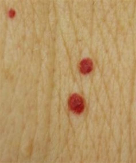 Red Moles Pictures Causes Treatment Removal