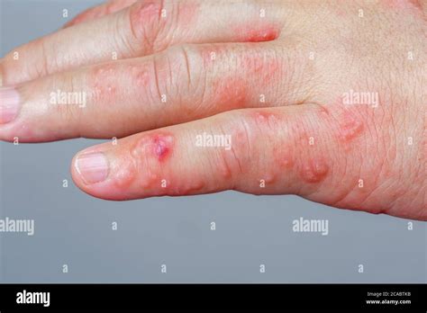 Skin Blistering High Resolution Stock Photography And Images Alamy