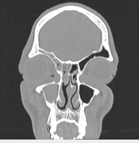 Opacification Of The Right Maxillary Ethmoid And Frontal Sinuses On