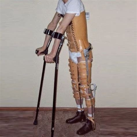 Leather And Stainless Steel Leg Braces At Best Price In Bhopal Renew Hi Tech Artificial Limb