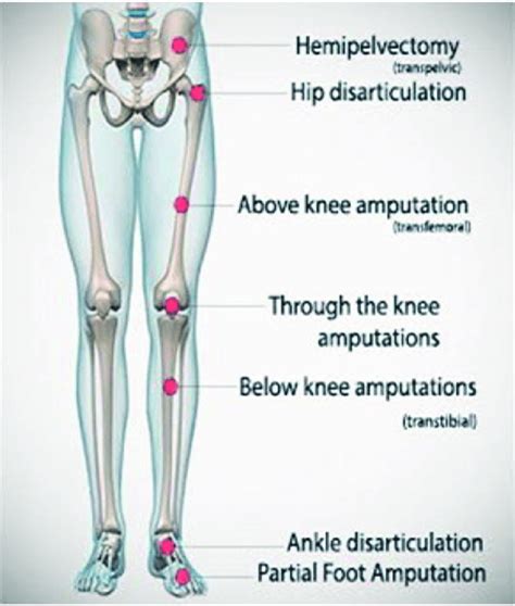 Levels Of Amputation Download Scientific Diagram