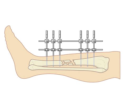 Cross Section Biomedical Illustration Of Internal Position External