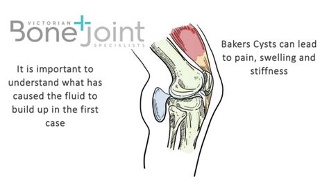 Bakers Cyst Ppt