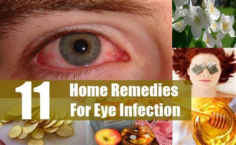 Home Remedies For Eye Infectionzip Eye Infections