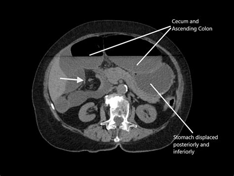 Cureus A Twisted Cecum Herniation And Volvulus Of The Cecum Through
