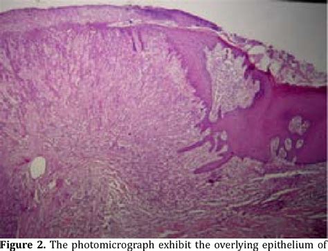 Figure 2 From Pyogenic Granuloma Mimicking A Cutaneous Horn On The Lip
