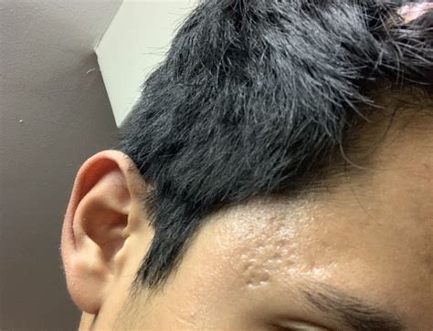 Acne Scarring On Forehead And Temples Please Help Scar Treatments