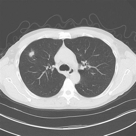 Tackling Lung Cancer A Multidisciplinary Approach To