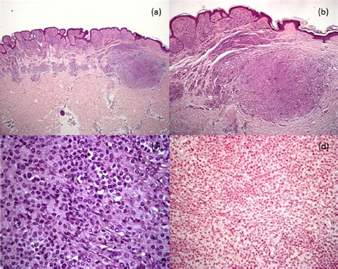 Histological Findings A Junctional And Dermal Melanocytic Congenital