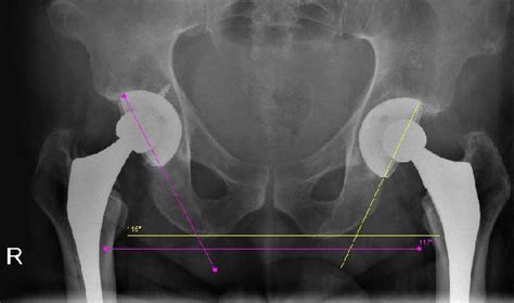 Both Acetabular Components Were Well Fixed An Excessive Inclination