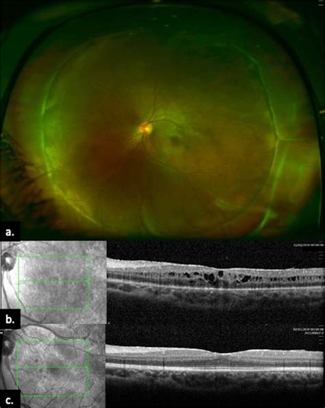 A One Year After Surgical Intervention Flat Retina With Good 360