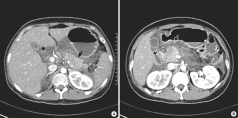 Contrast Enhanced Pancreas Ct Scan Arterial Phase In