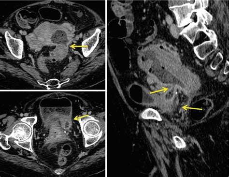 Acute Perforated Diverticulitis Spectrum Of Mdct Findings Radiology Key