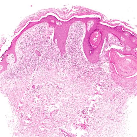 B Hyperkeratotic Papules And Plaques Arranged Linearly Over The Arms