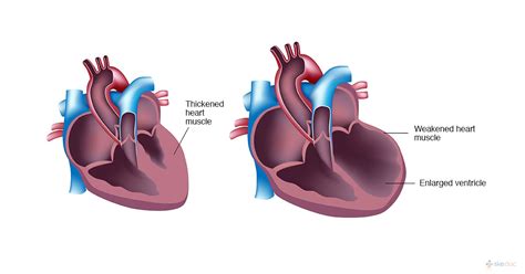 Heart Enlargement Causes Risk Factors Diagnosis And Prognosis
