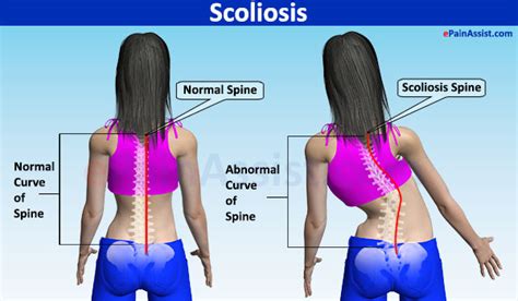 Real Health Treatments Scoliosis Symptoms Causes And Treatments