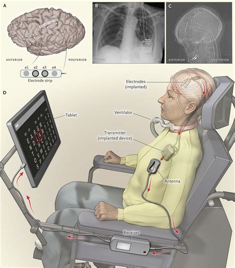 Fully Implanted Brain Computer Interface In A Locked In Patient With Als Nejm