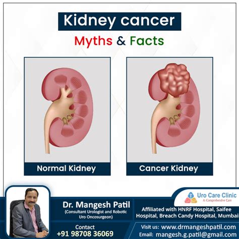 Kidney Cancer Myths And Facts Uro Care Clinic
