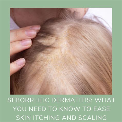 Seborrheic Dermatitis What You Need To Know To Ease Skin Itching And