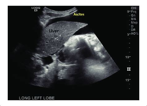 Ascites Liver Ultrasound