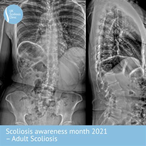 Blog Scoliosis Clinic Uk Treating Scoliosis Without Surgery