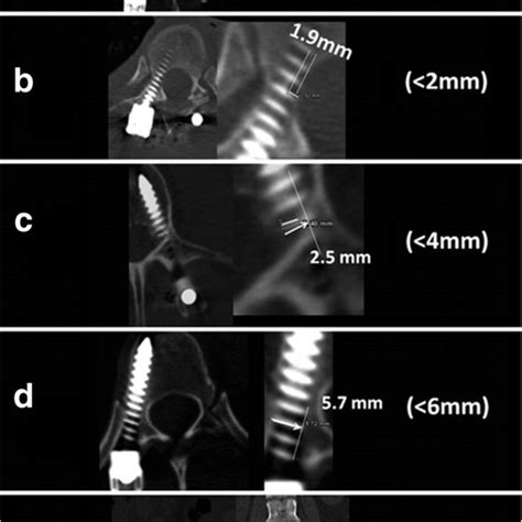 Lateral Mass Screw Insertion Techniques Lm Lateral Mass Download Scientific Diagram