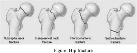 Solved What Are The Different Types Of Lower Extremity Fractures With