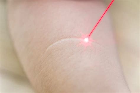 Laser Scar Removal Types Of Scars That Can Be Treated