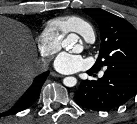 Bicuspid Aortic Valve With Calcification And Dilated Aortic Root