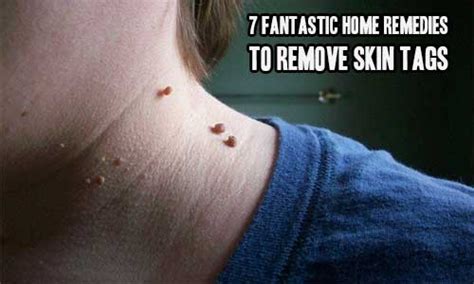 7 fantastic home remedies to remove skin tags iseeidoimake