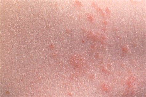 Skin Rashes In Children