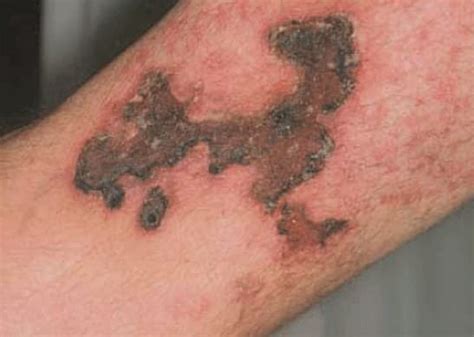Calciphylaxis Pictures Symptoms Diagnosis Treatment Causes Hubpages