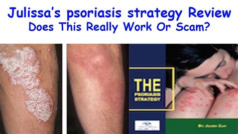 Psoriasis Strategy Review Julissas Psoriasis Strategy Pdf Youtube