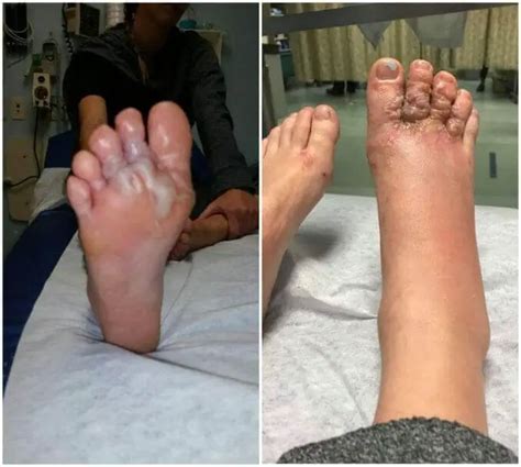 Young Couple Contracts Hookworms In Feet At Punta Cana Beach Resort