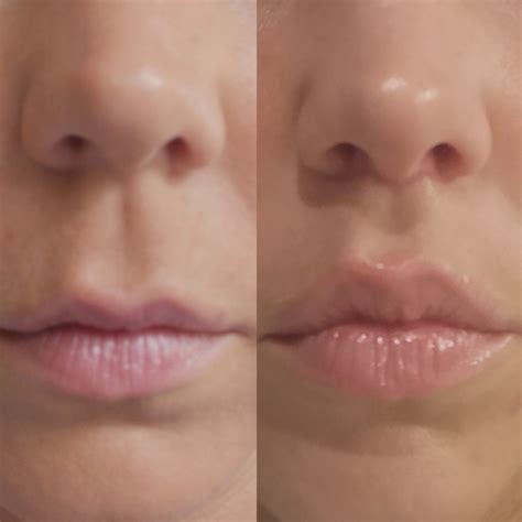 Lifting de la lèvre supérieur - Chirurgie esthétique Paris