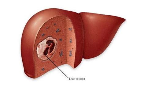 Liver Cancer Treatment Best Oncology Hospital In Delhi